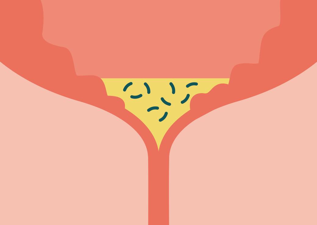 Was ist der Zusammenhang zwischen Restharn und Harnwegsinfektionen?