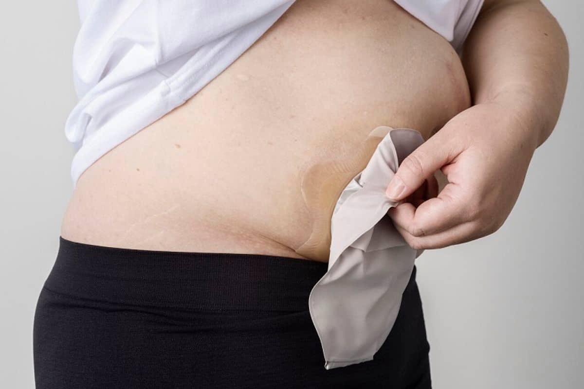 SenSura Mio Konkav Versorgung am Bauch
