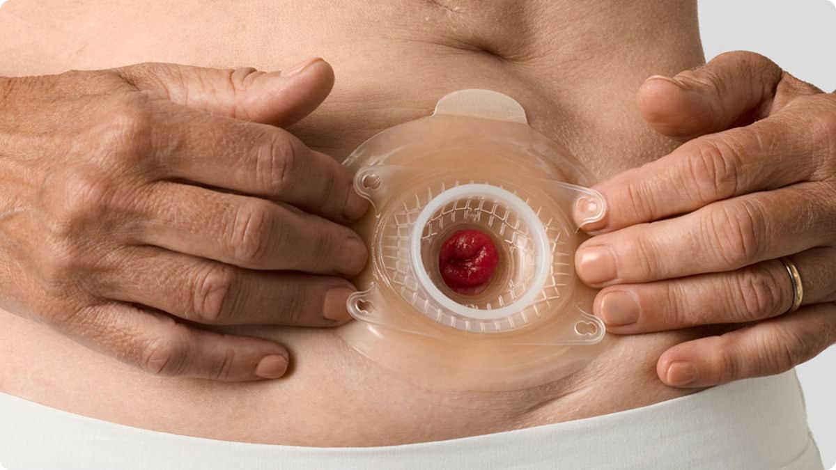 Hände platzieren eine konvexe Basisplatte über ein Urostoma am Bauch