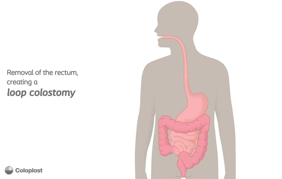 Loop Colostomy and end-to-end anastomosis