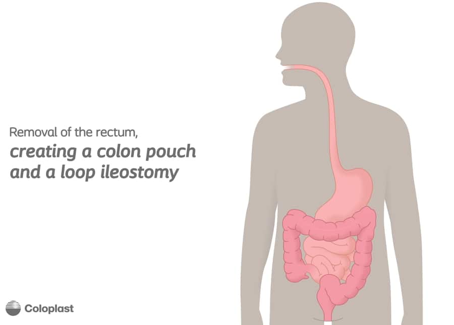 Loop Ileostomy and J Pouchv