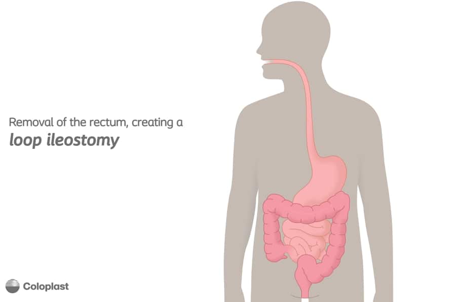 Loop Ileostomy and end-to-end anastomosis