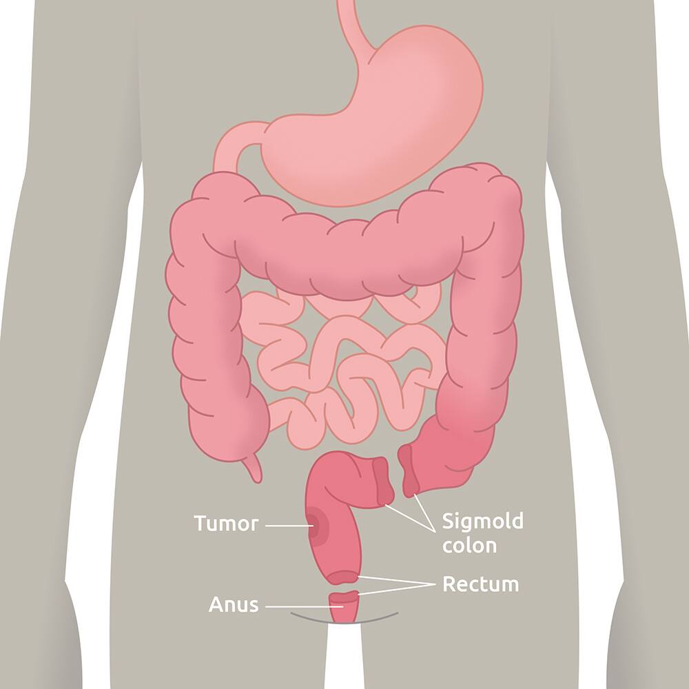 Low Anterior Resection Syndrome