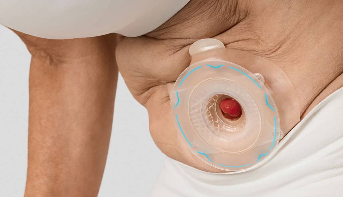 Person beugt sich nach vorne und hat eine konvexe Basisplatte über dem Stoma