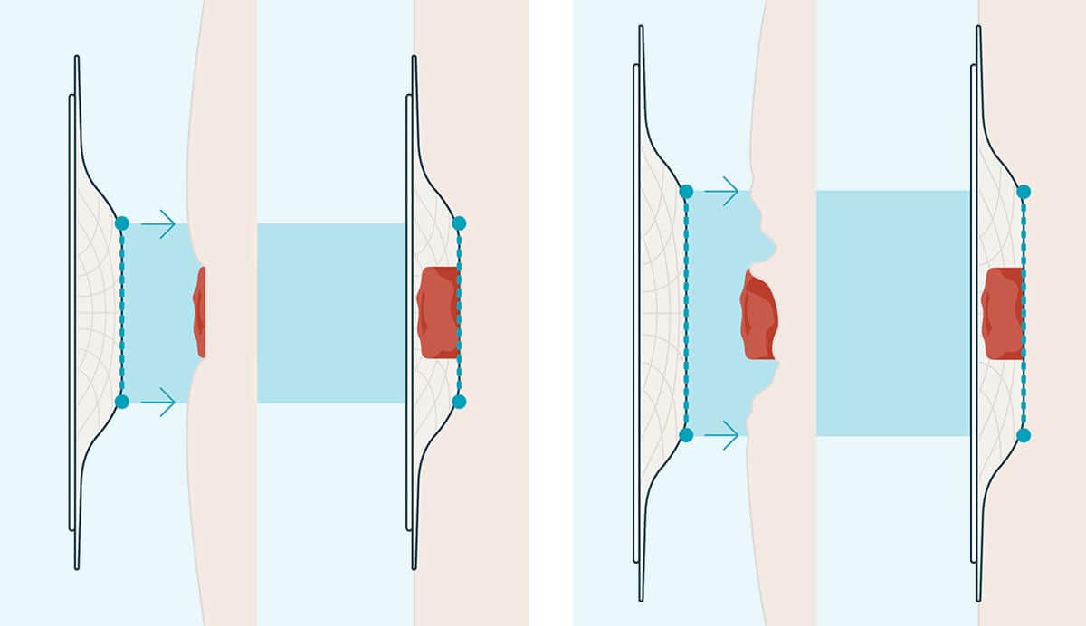 Illustration der konvexen Basisplatten und Passformen am Bauch