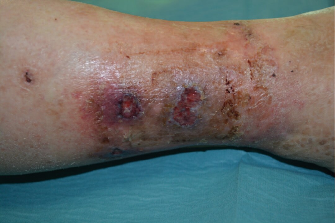 Behandlung eines arteriellen Ulcus cruris am Unterschenkel