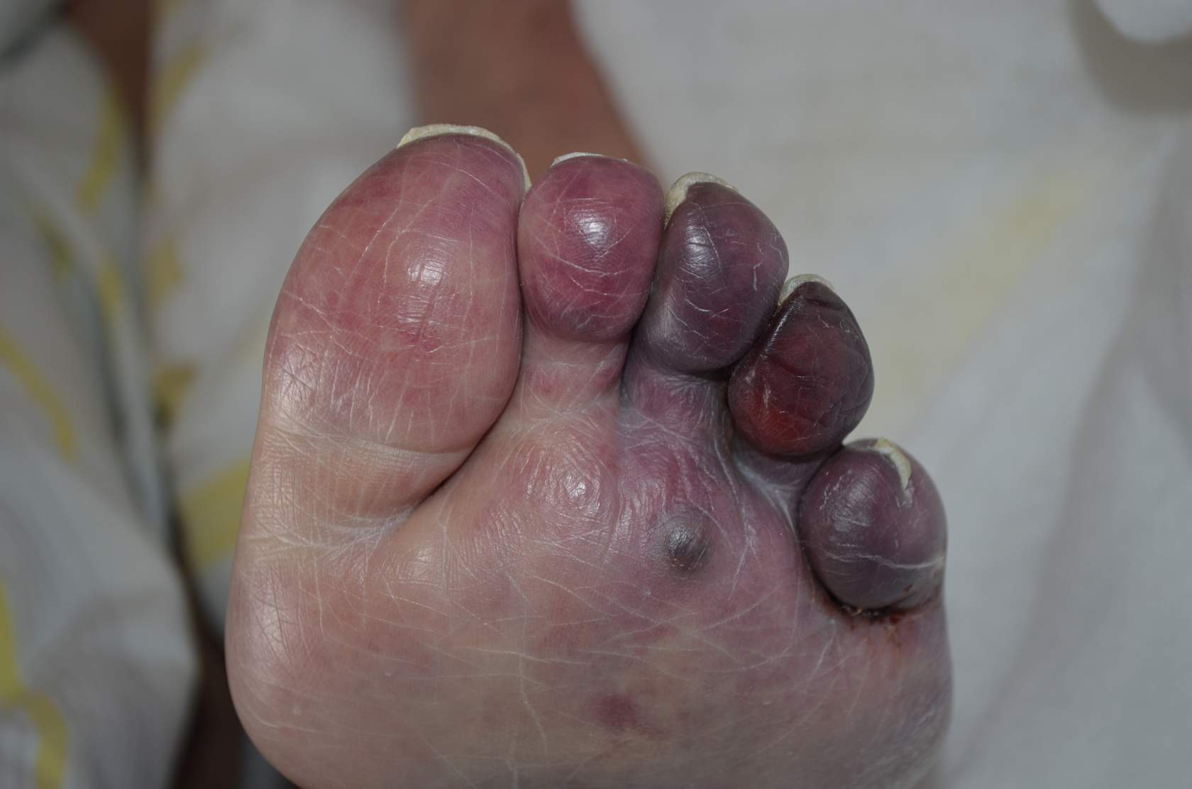 Ulcus cruris arteriosum