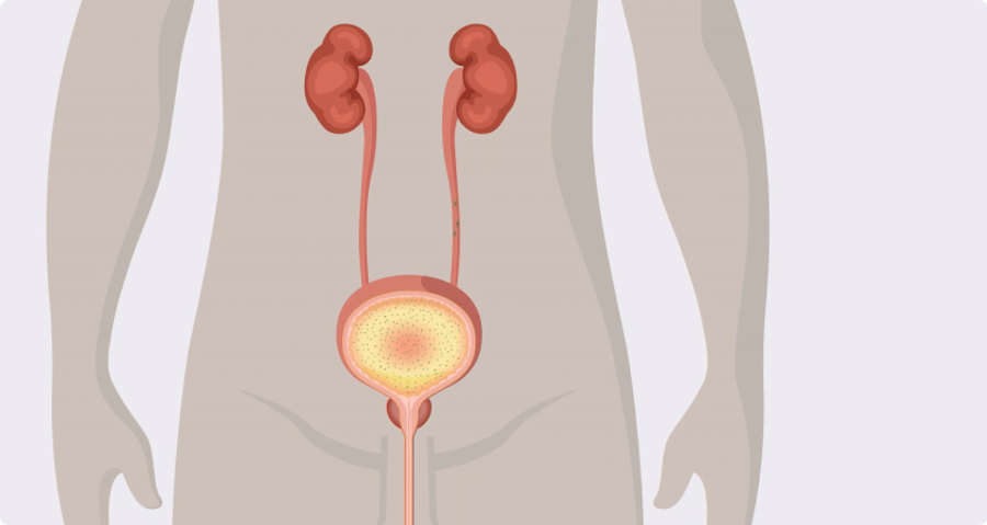 How bacterial growth increases the UTI risk
