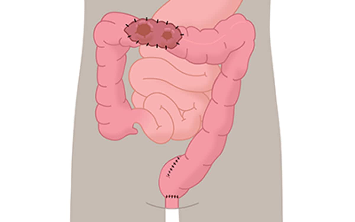 Doppelläufiges Kolostoma