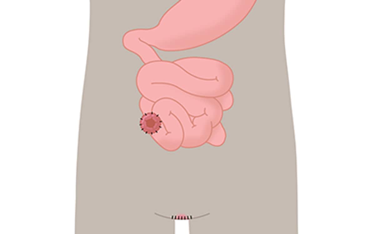 Endständige Ileostomie