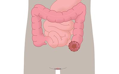 Was ist ein Urostoma? | Stomaversorgung