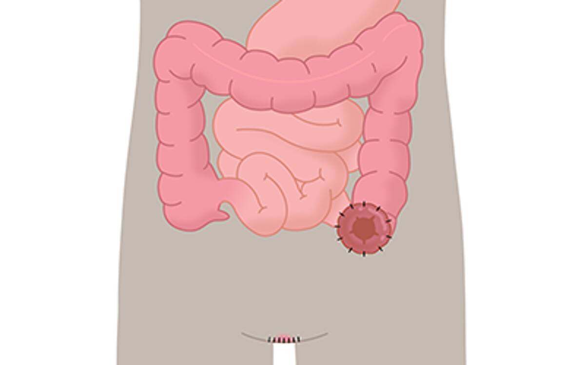 Endständige Kolostomie