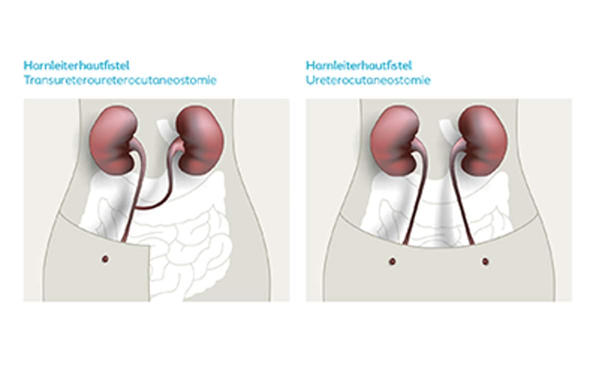 Illustration Harnleiterhautfistel mit Beschriftungen