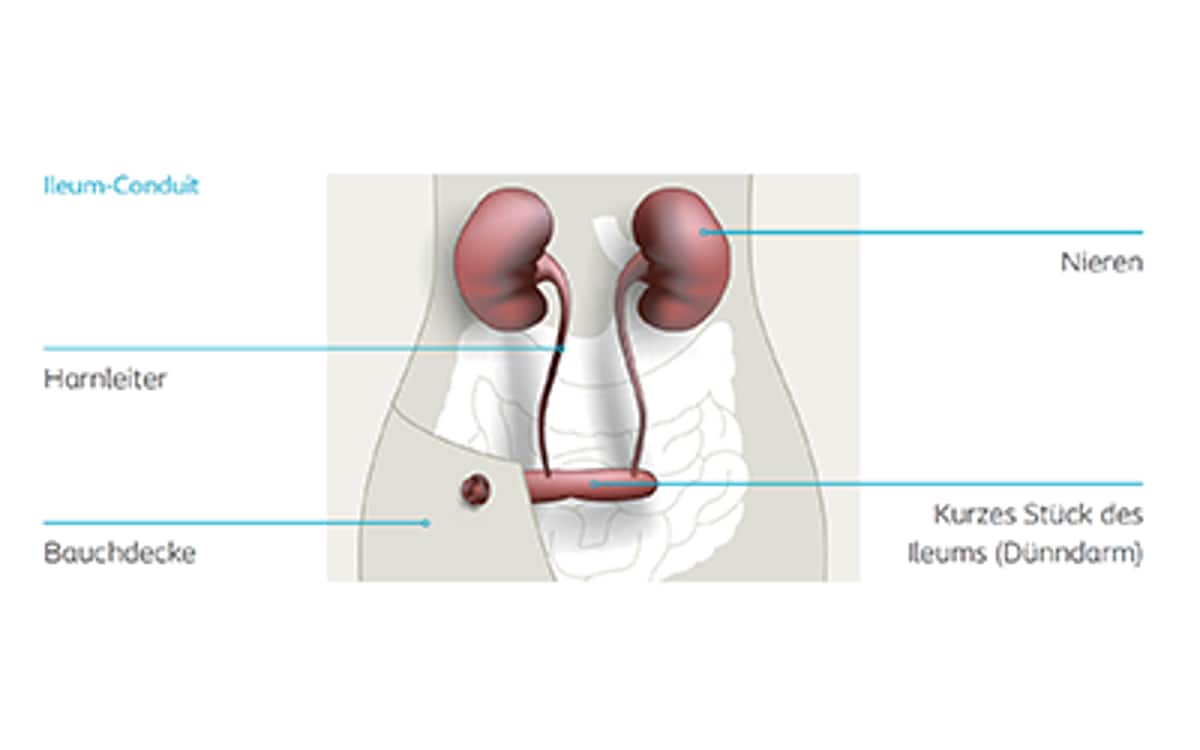 Illustration Ileum-Conduit mit Beschriftungen