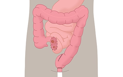 Illustration Doppelläufiges Ileostoma