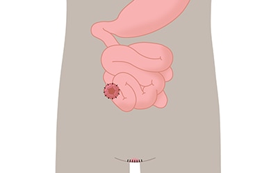 Illustration Endständiges Ileostoma