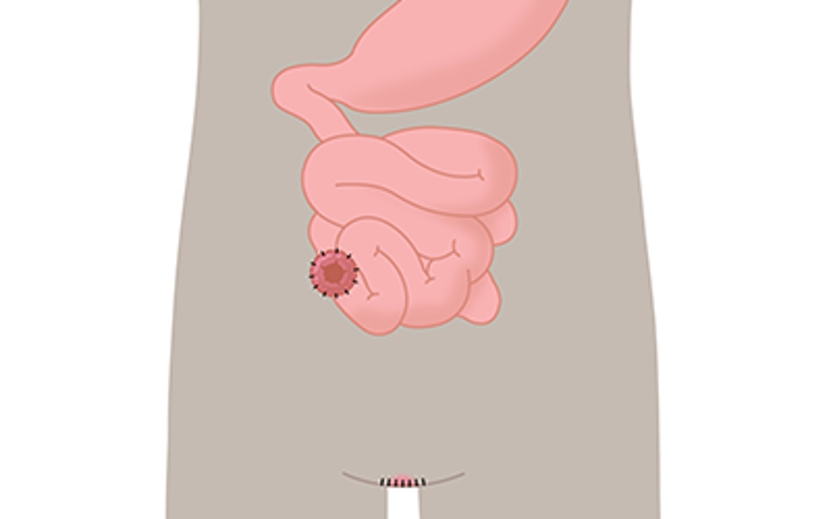Endständige Ileostomie