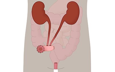 Urostoma