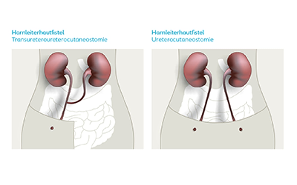 Illustration Harnleiterhautfistel mit Beschriftungen