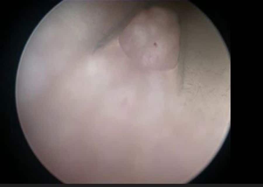 Tissue gets sucked into the catheter eyelets
