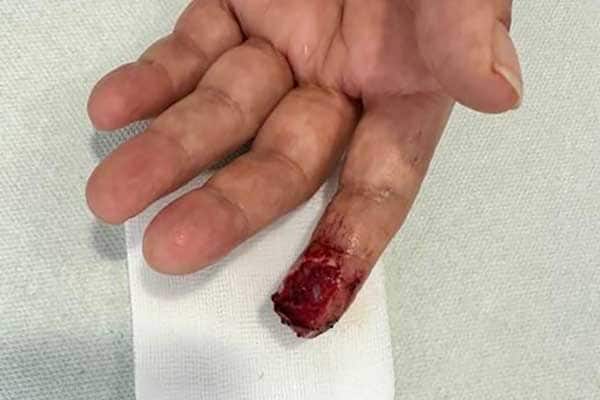 Schnittwunde am Finger Tag 0
