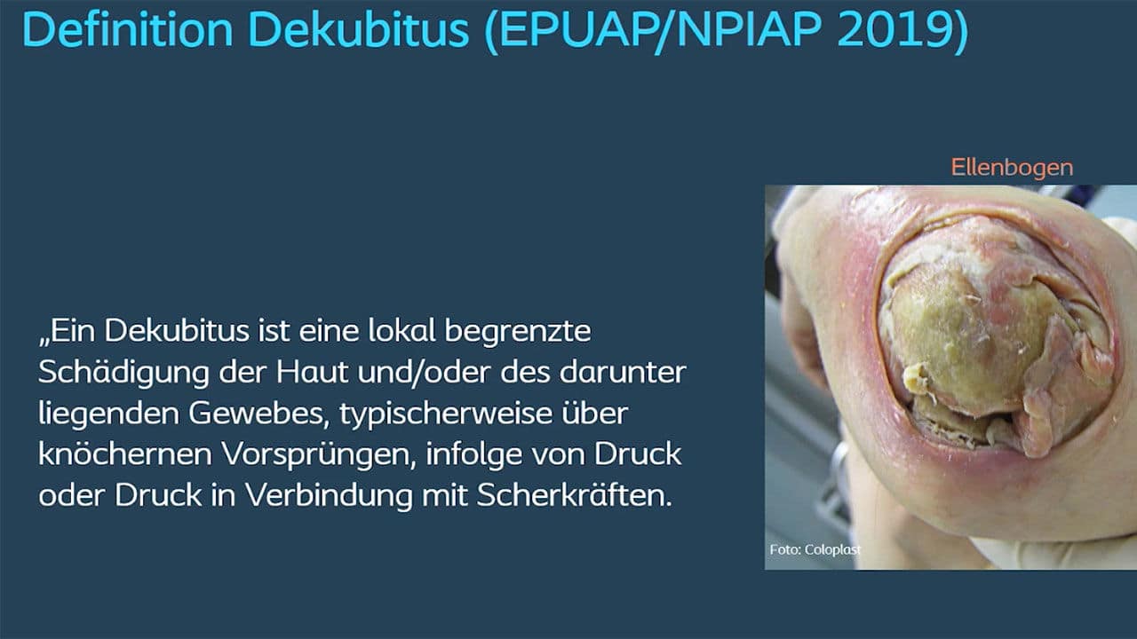 Dekubitus muss nicht sein – Prävention und Behandlung