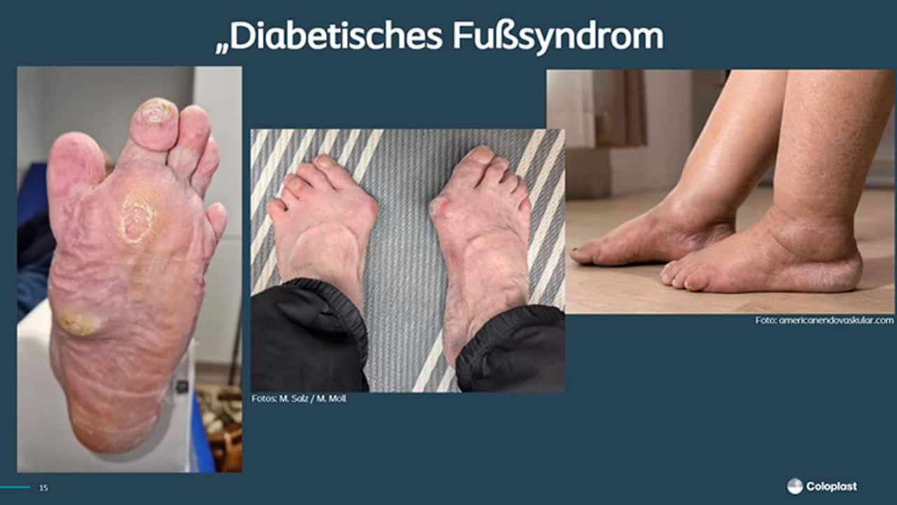Das diabetische Fußsyndrom