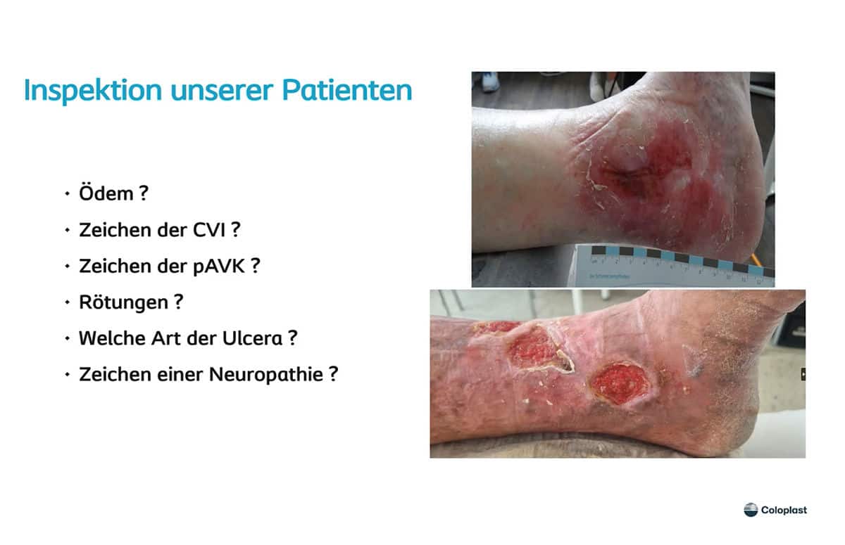 Ulcus cruris – Ursachen und Therapie
