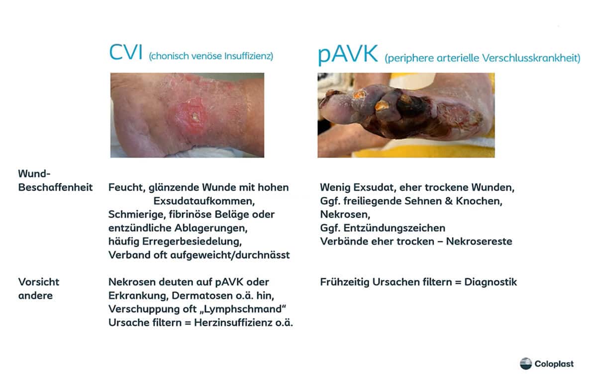 Teaser: Ulcus cruris – Ursachen und Therapie