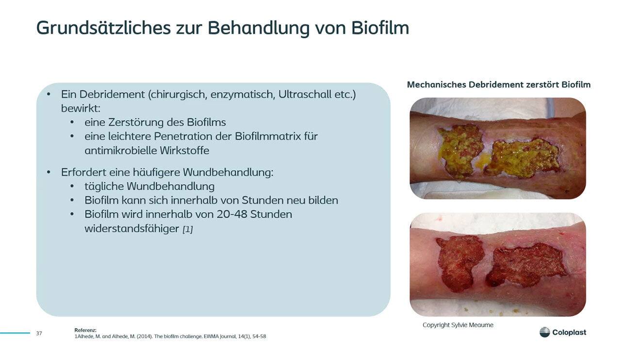 Was ist los auf der Wunde? Wie erkenne ich Biofilm & co.?